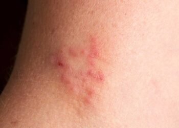 Case Studies: Recovery from Mold-Induced Skin Conditions