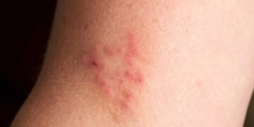 Case Studies: Recovery from Mold-Induced Skin Conditions