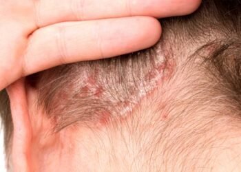 Could Mold Be Aggravating Your Psoriasis Symptoms?