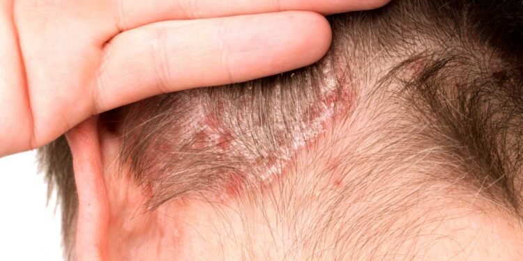 Could Mold Be Aggravating Your Psoriasis Symptoms?