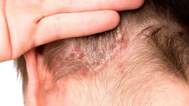 Could Mold Be Aggravating Your Psoriasis Symptoms?