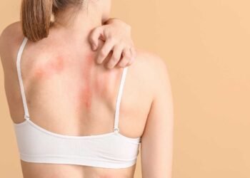 Could Mold Be the Cause of Your Rashes?