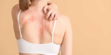 Could Mold Be the Cause of Your Rashes?