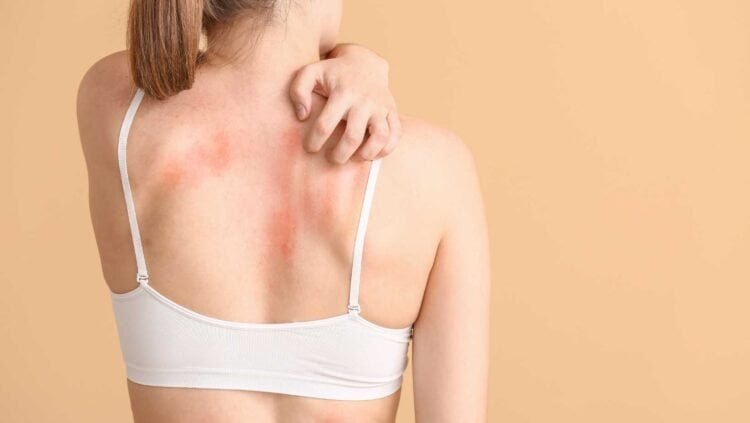 Could Mold Be the Cause of Your Rashes?