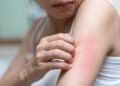 Identifying Mold-Related Skin Rashes: Symptoms and Signs