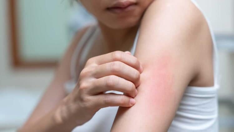 Identifying Mold-Related Skin Rashes: Symptoms and Signs