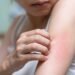 Identifying Mold-Related Skin Rashes: Symptoms and Signs