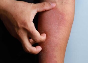 Managing Skin Irritation Caused by Mold Exposure: Tips and Remedies