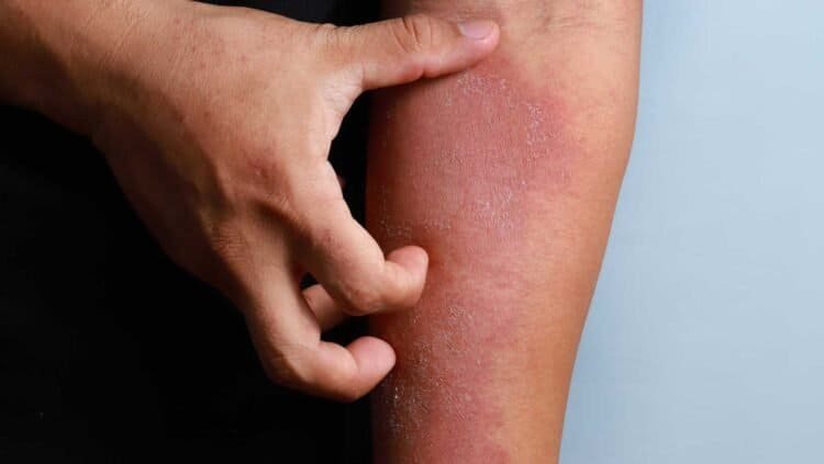 Managing Skin Irritation Caused by Mold Exposure: Tips and Remedies