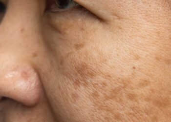 Mold Exposure and Long-Term Skin Health: Emerging Research Findings