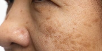 Mold Exposure and Long-Term Skin Health: Emerging Research Findings