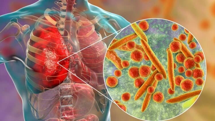 Mold Spores and Their Impact on Airway Inflammation: What You Need to Know