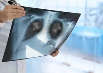 Hypersensitivity PneumonitisHypersensitivity Pneumonitis