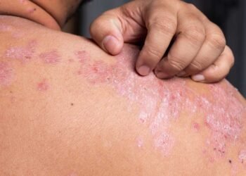 Mold in the Home: Addressing Dermatitis at its Root Cause