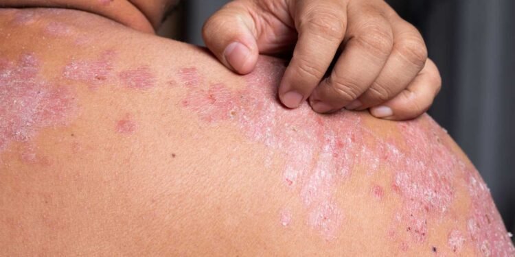 Mold in the Home: Addressing Dermatitis at its Root Cause