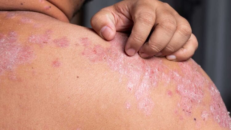 Mold in the Home: Addressing Dermatitis at its Root Cause