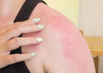 Preventive Measures: Protect Your Skin from Mold Allergens
