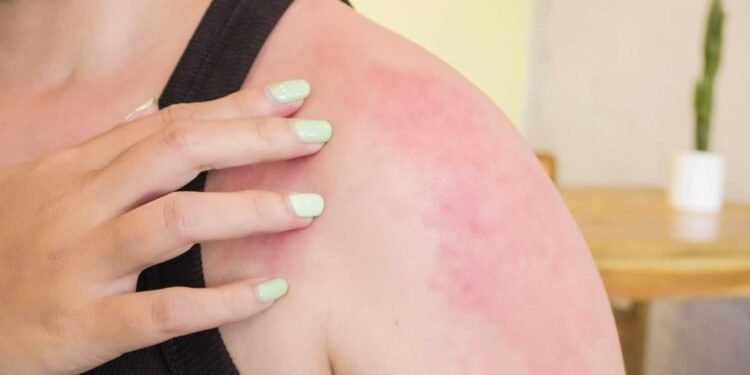 Preventive Measures: Protect Your Skin from Mold Allergens