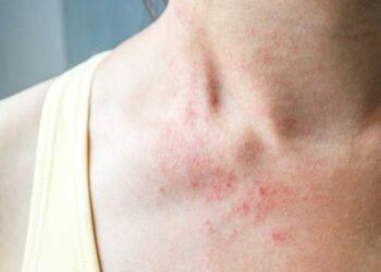 The Link Between Mold and Eczema: What You Need to Know