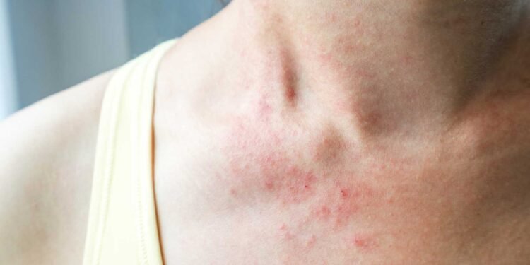 The Link Between Mold and Eczema: What You Need to Know