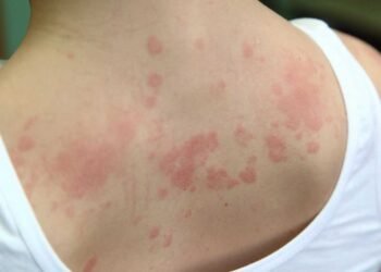 The Role of Humidity in Mold Growth and Skin Conditions Explained