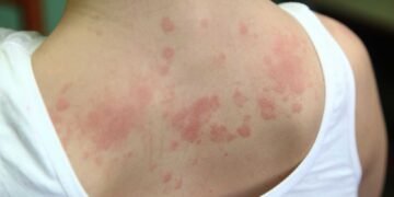 The Role of Humidity in Mold Growth and Skin Conditions Explained