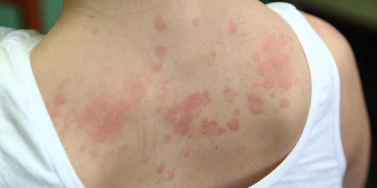 The Role of Humidity in Mold Growth and Skin Conditions Explained