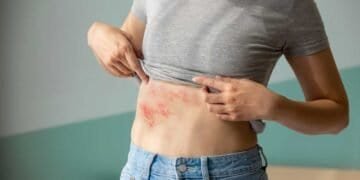 The Science Behind Mold: Its Potential to Cause Hives