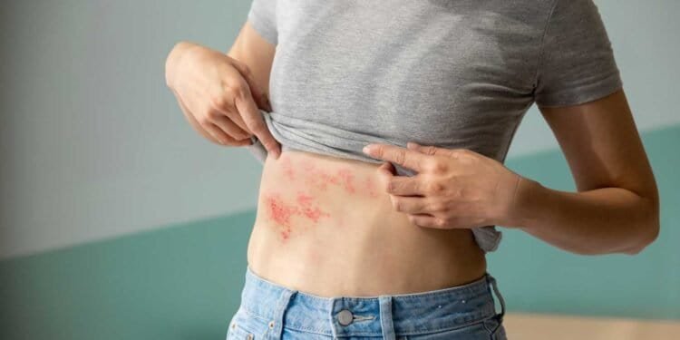 The Science Behind Mold: Its Potential to Cause Hives