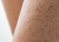 Why Some People Are More Susceptible to Mold-Related Skin Issues