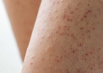 Why Some People Are More Susceptible to Mold-Related Skin Issues