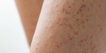 Why Some People Are More Susceptible to Mold-Related Skin Issues