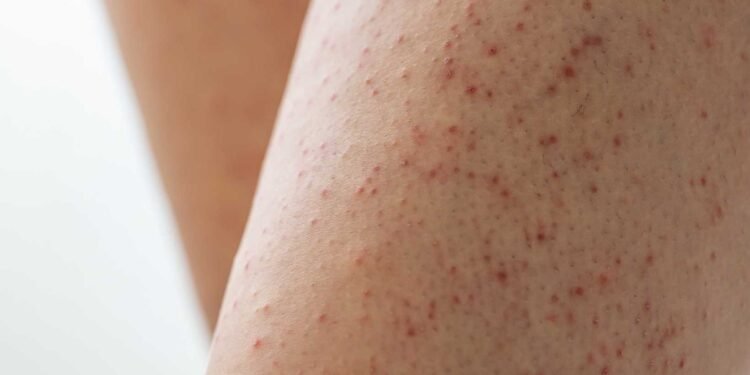 Why Some People Are More Susceptible to Mold-Related Skin Issues