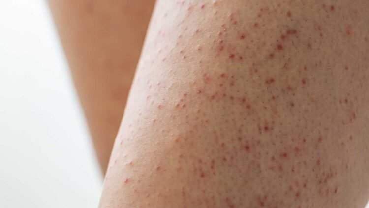 Why Some People Are More Susceptible to Mold-Related Skin Issues