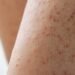 Why Some People Are More Susceptible to Mold-Related Skin Issues