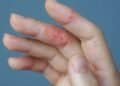 Could Mold Be Causing or Aggravating Your Eczema Symptoms?