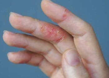 Could Mold Be Causing or Aggravating Your Eczema Symptoms?