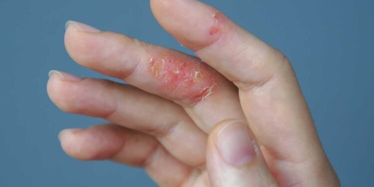 Could Mold Be Causing or Aggravating Your Eczema Symptoms?