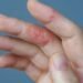 Could Mold Be Causing or Aggravating Your Eczema Symptoms?