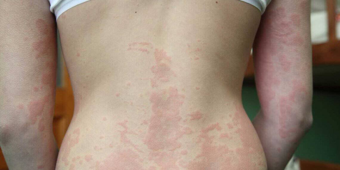 Could Mold be the Cause or Aggravator of Your Dermatitis Symptoms ...