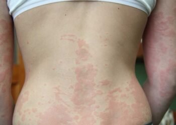Could Mold be the Cause or Aggravator of Your Dermatitis Symptoms?