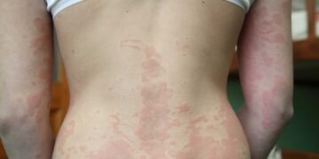 Could Mold be the Cause or Aggravator of Your Dermatitis Symptoms?