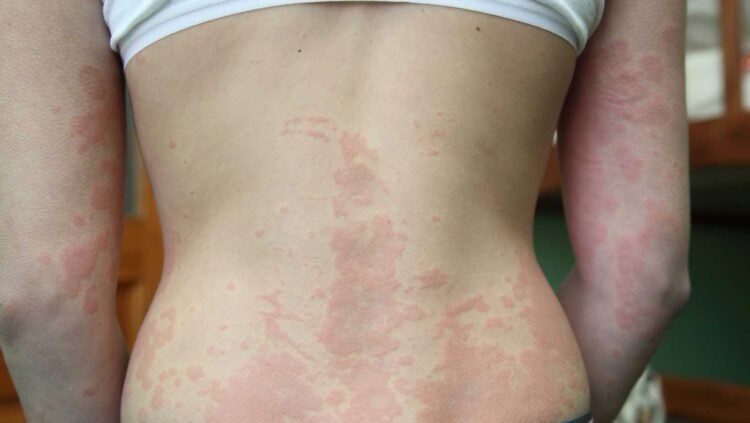 Could Mold be the Cause or Aggravator of Your Dermatitis Symptoms?