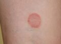 Could Mold be the Culprit Behind Your Ringworm Symptoms?