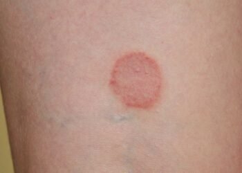 Could Mold be the Culprit Behind Your Ringworm Symptoms?