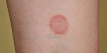 Could Mold be the Culprit Behind Your Ringworm Symptoms?