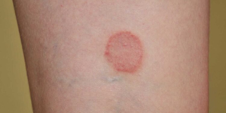 Could Mold be the Culprit Behind Your Ringworm Symptoms?