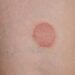 Could Mold be the Culprit Behind Your Ringworm Symptoms?