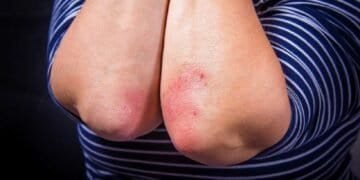 Understanding the Connection Between Mold and Psoriasis Flare-Ups: A Comprehensive Guide
