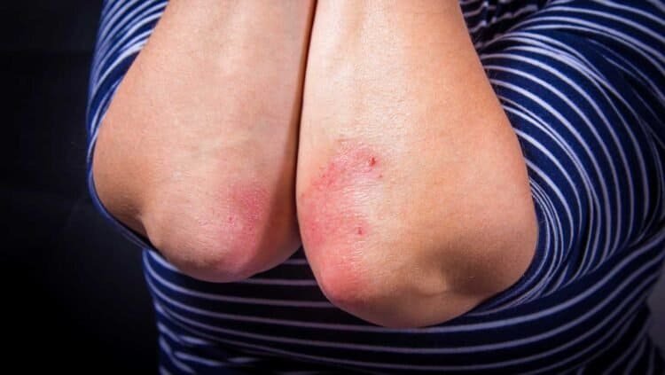 Understanding the Connection Between Mold and Psoriasis Flare-Ups: A Comprehensive Guide